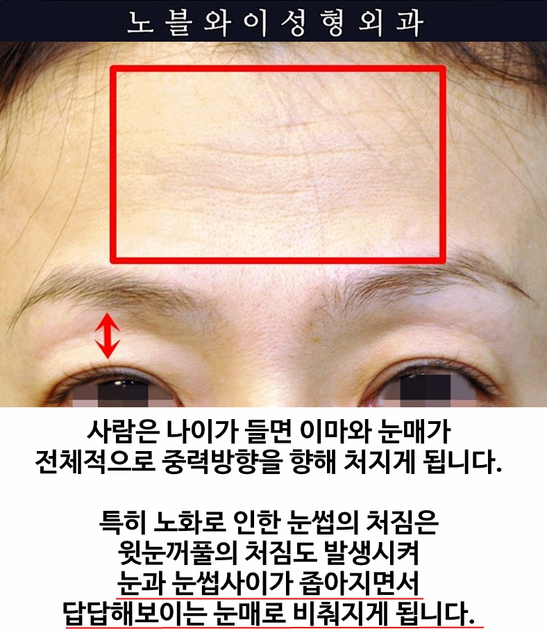  눈처짐 리프팅 하려면 눈썹도 같이