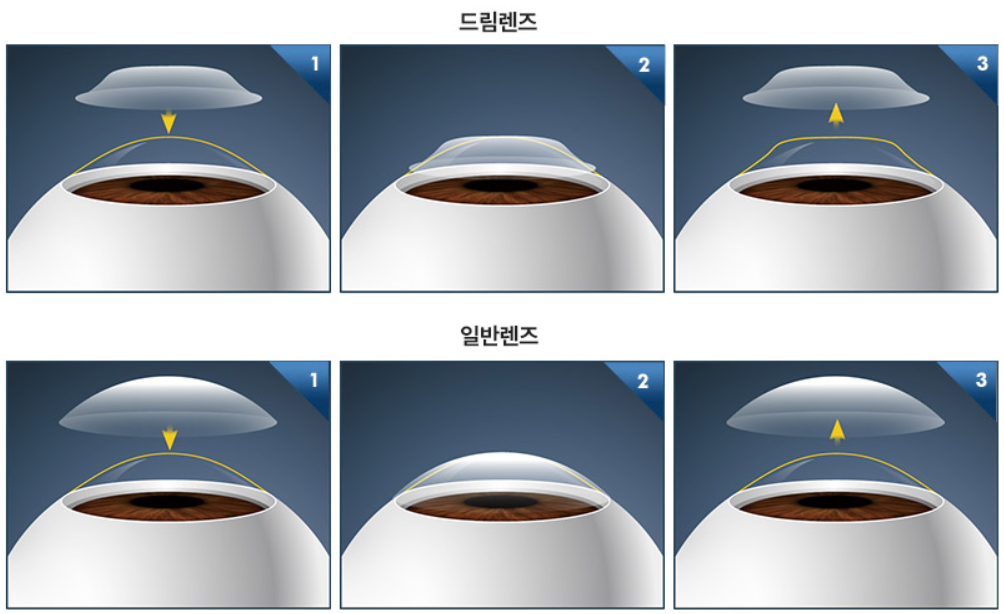 드림렌즈