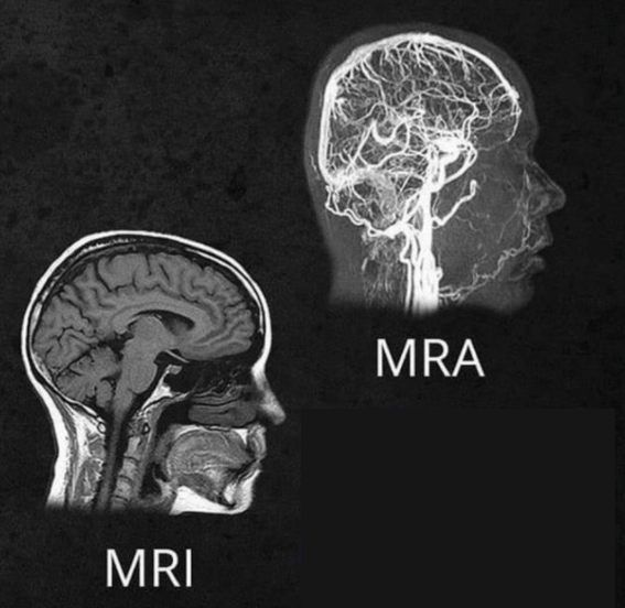 뇌 MRI MRA 차이점