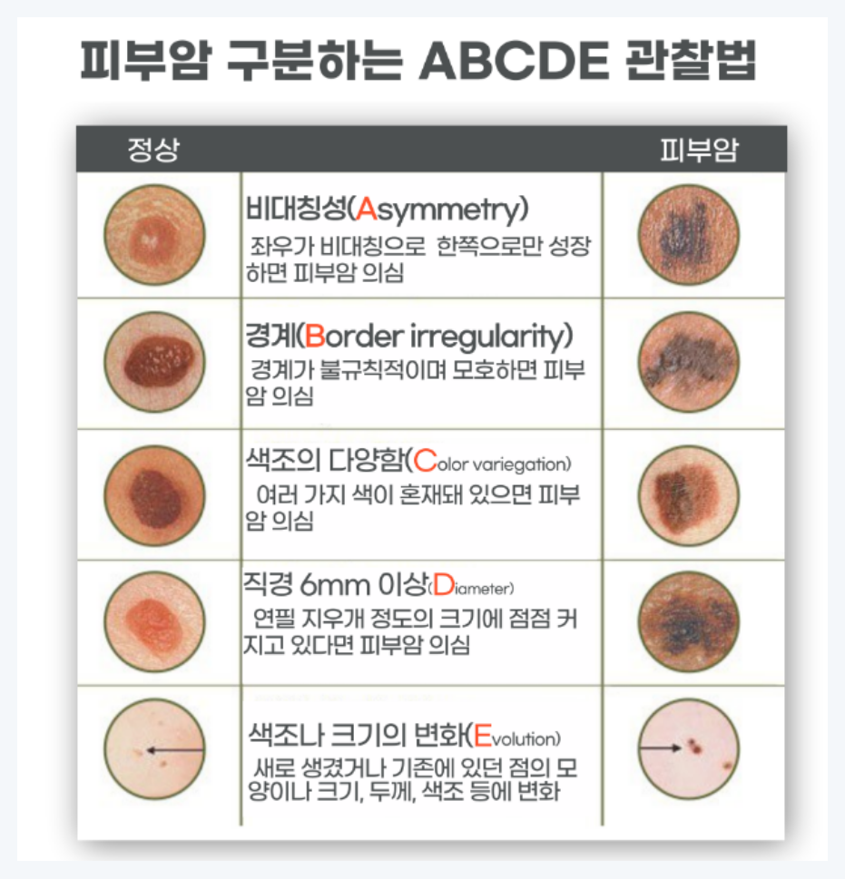 피부암 ABCDE 관찰법