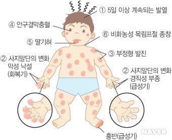  내 아이! 가와사키병? 코로나 바이러스(COVID-19)? 절대 그냥 넘어가지 마세요!