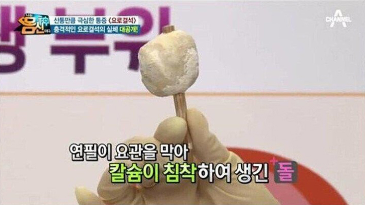  여자 요로결석 레전드