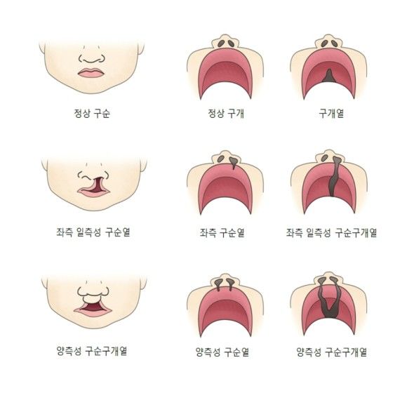 언청이 수술