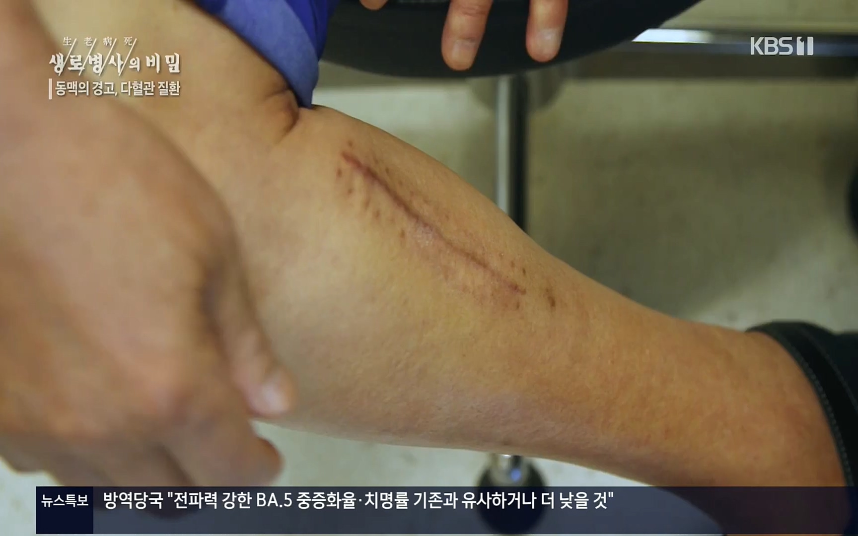 생로병사의 비밀.E831.220817p.H264-F1RST.mp4_20220822_185324.999.jpg