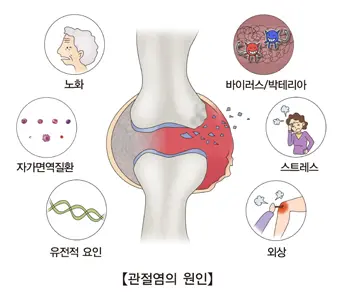 관절염