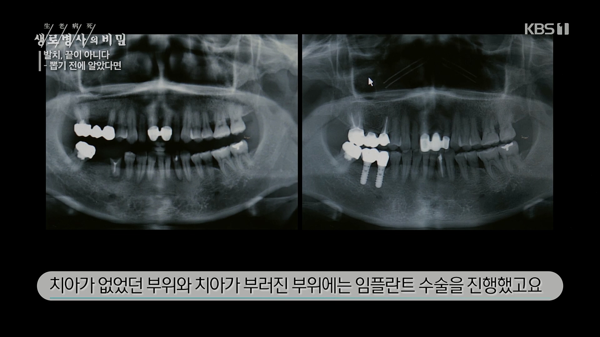 생로병사의 비밀.E855.230208p.H264-F1RST.mp4_20230214_194929.555.jpg
