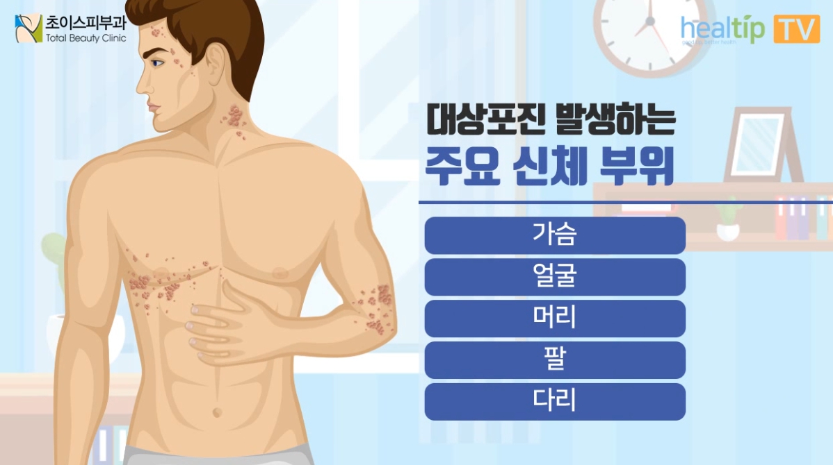 대상포진이 발생하는 신체부위