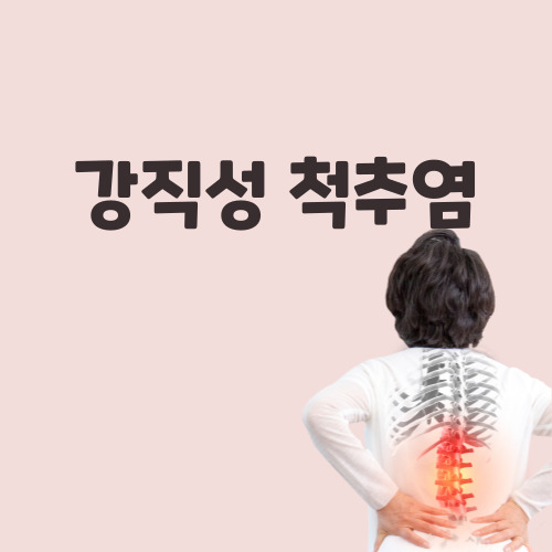  강직성 척추염 증상 및 치료방법