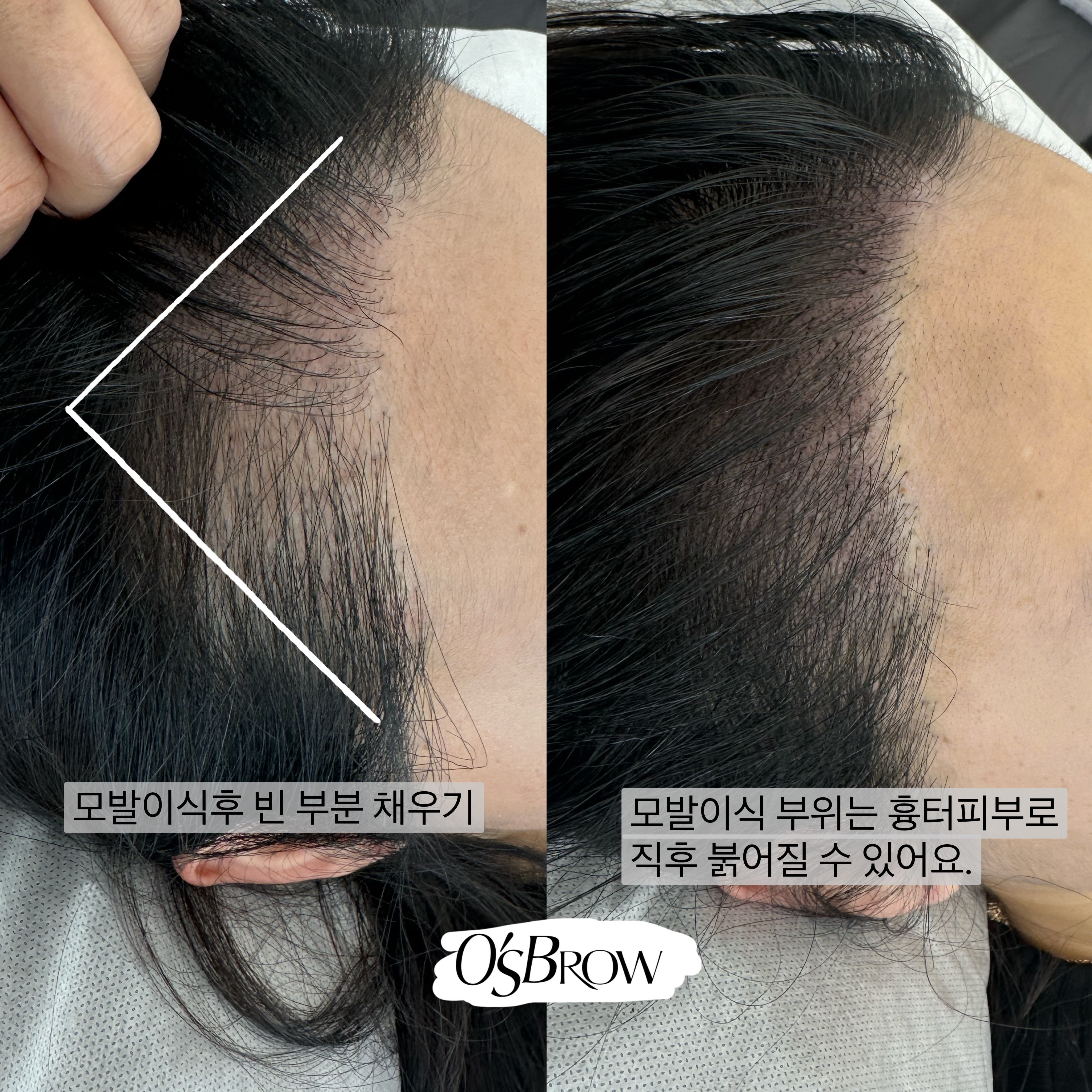 오즈헤어라인 이미지