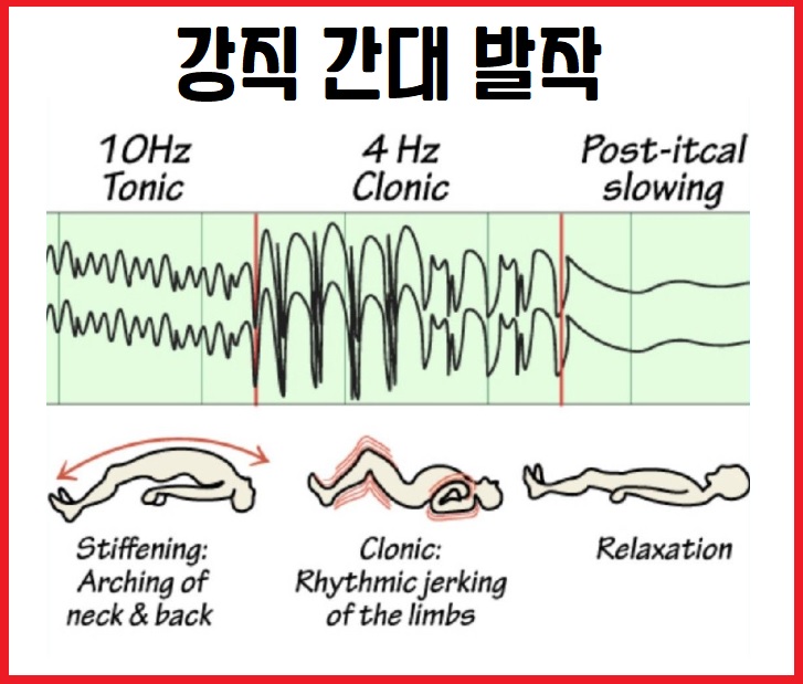 강직 간대 발작 병태생리와 특징 완벽 정리