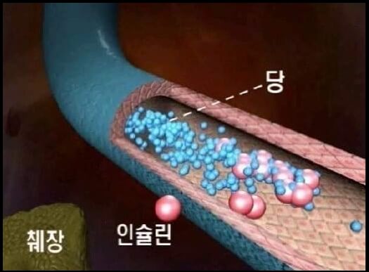  당뇨병 초기증상, 당뇨 자가진단