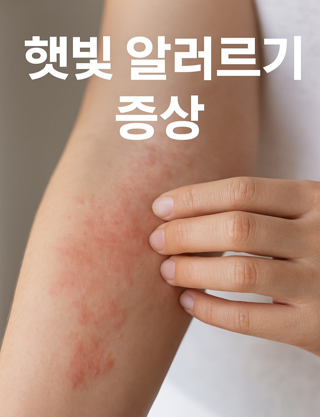 햇빛에 노출된 여성의 피부 클로즈업 사진 위에 &quot;햇빛 알레르기 증상과 치료법&quot;이라는 텍스트가 중앙에 삽입된 경고형 썸네일 이미지.