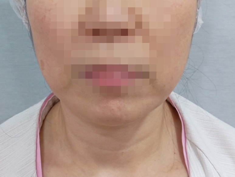  얼굴지방흡입 얼굴지방이식 안면윤곽수술 얼굴필러 얼굴보형물 얼굴성형 부작용 효과 붓기 멍 이중턱지방흡입
