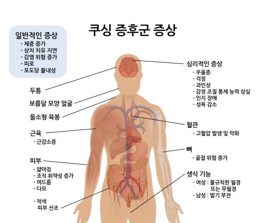 쿠싱증후군 부위별 증상