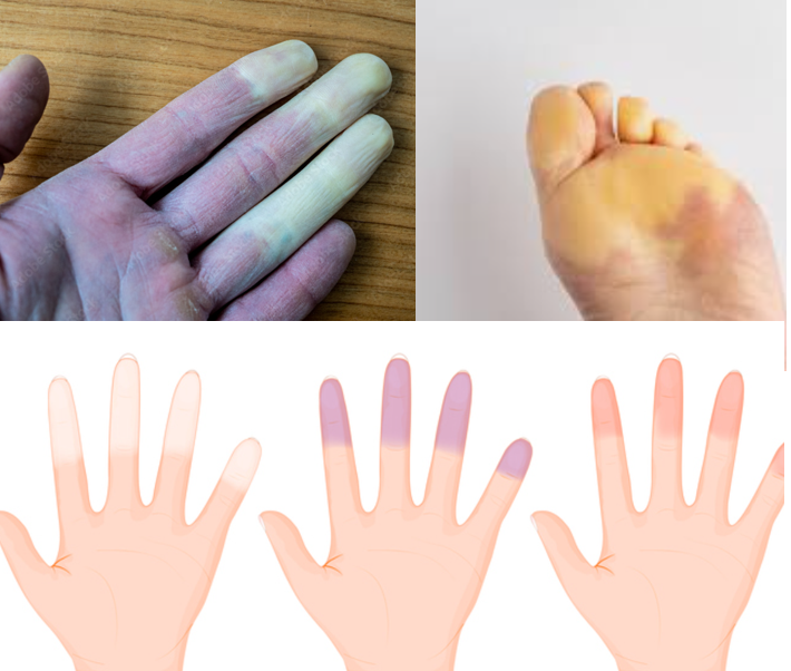 레이노 병 (레이노 증후군) 손 색 창백하게 흰색으로 변화