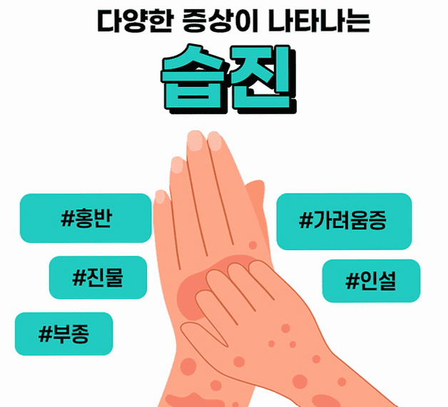  주부습진 원인, 증상, 치료방법, 관리방법 총정리 / 주부습진 이젠 안녕!