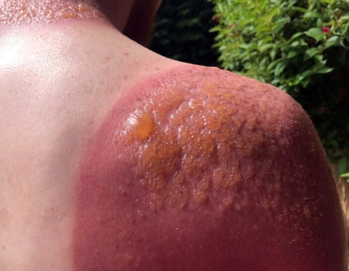 일광화상[Sunburn] 사진