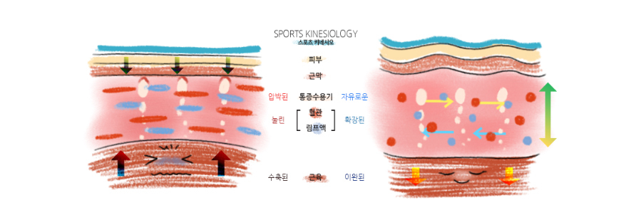 테이핑의 원리