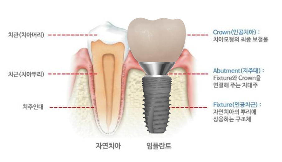 임플란트 이미지