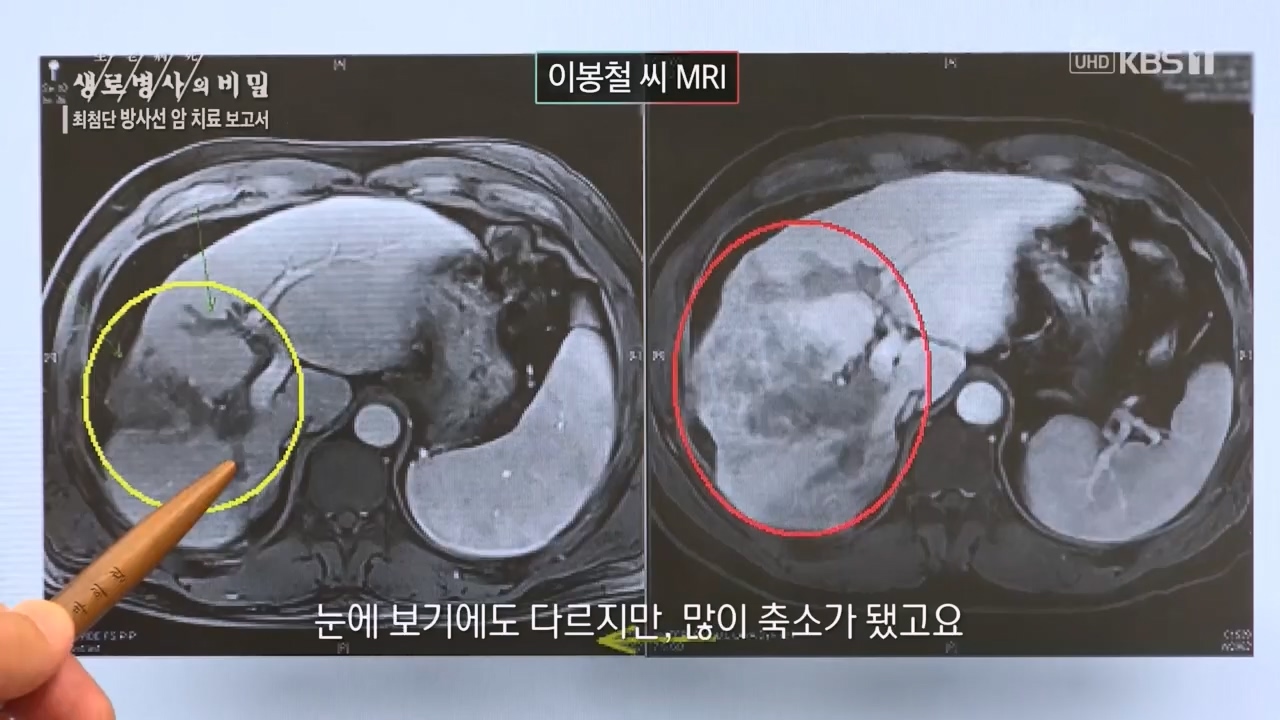 생로병사의 비밀.E896.240132p.H264-F1RST.mp4_20240202_195825.853.jpg