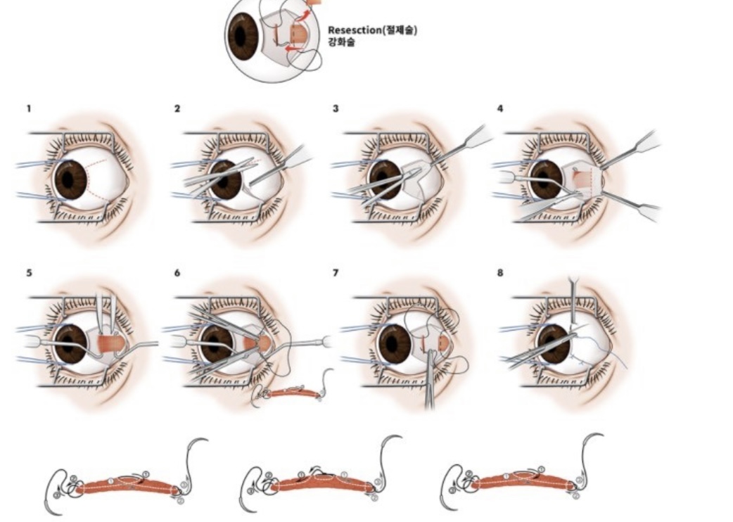 Resection of one extraocular muscle