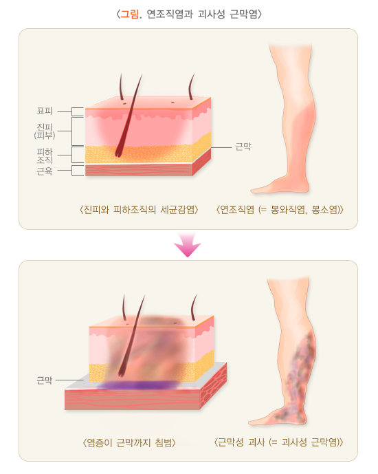 연조직염