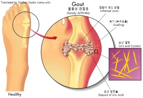통풍 관련 이미지