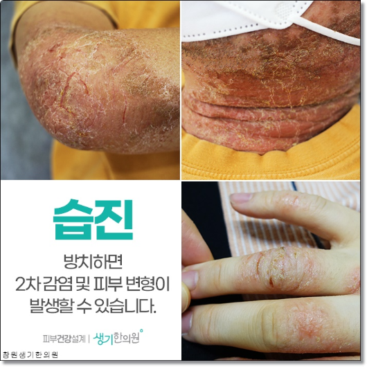 마산습진 치료의 비결은 안정적인 생활습관을 유지하는 것입니다. 4
