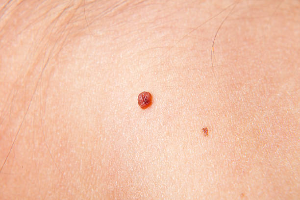 Understanding the Risks and Removal Methods of Warts on the Skin.