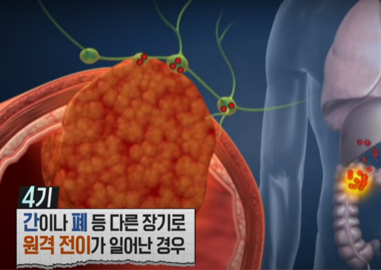 대장암 4기 간이나 폐 등 다른 장기로 원격전이가 일어난 경우