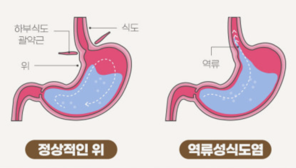 역류성 식도염 원인 및 증상