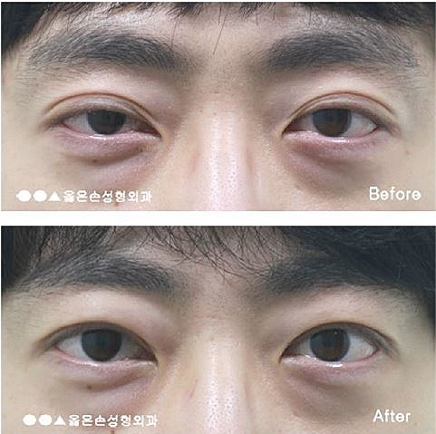 눈꺼풀을 어려 보이게 만드는 방법 6