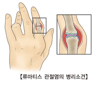 류마티스 관절염 (출처: 서울아산병원)