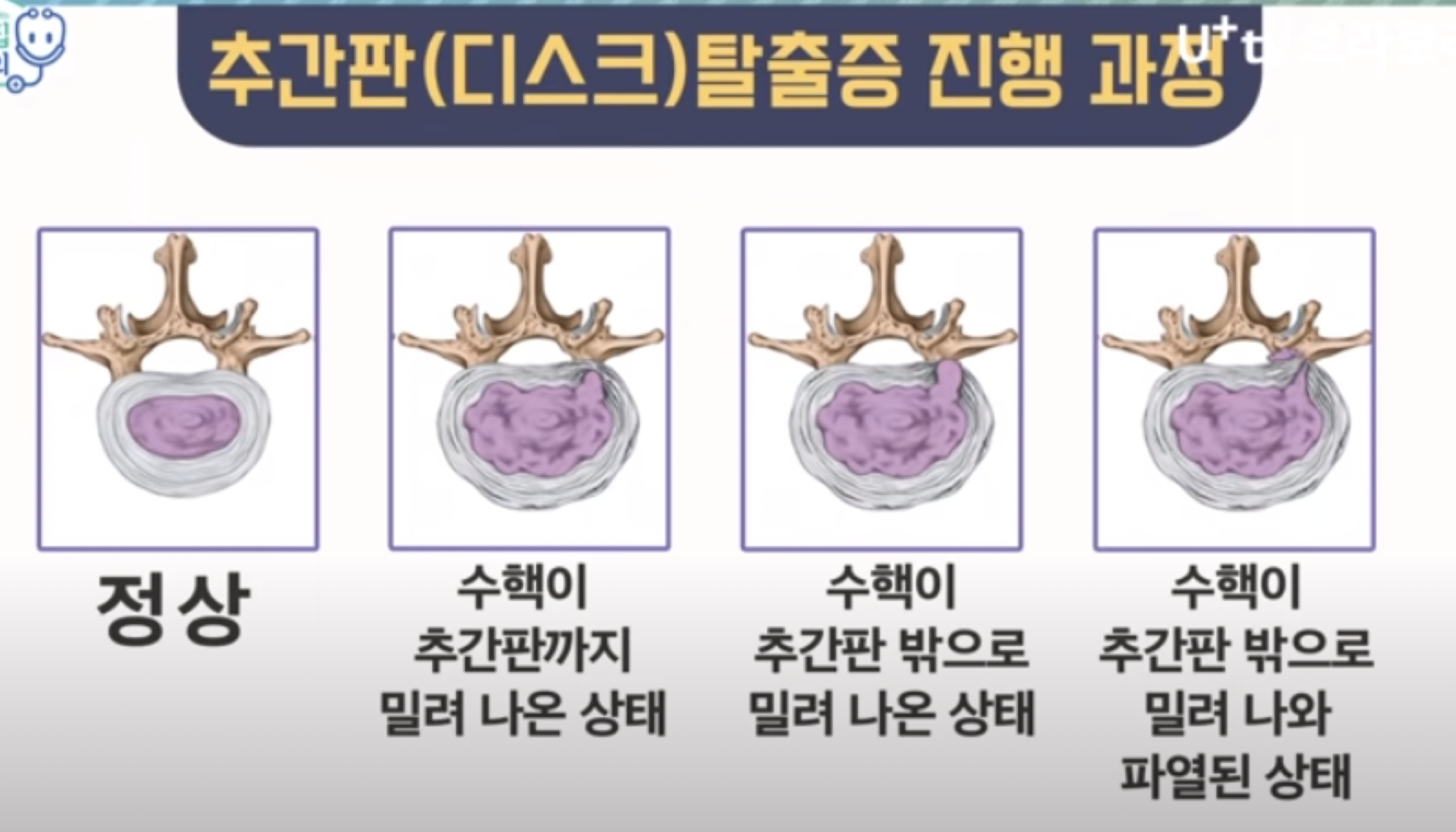 디스크 탈출증 진행과정