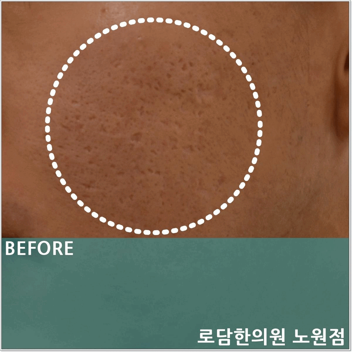  여드름흉터한의원 새살침 코라테라피의 치료 원리는?