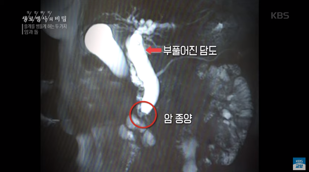  담도암이란? 담도암 생존율 증상은?