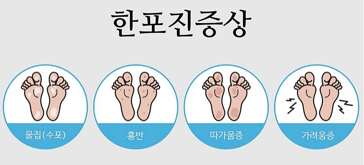 발바다한포진 완벽 정복하기: 원인&#44; 증상&#44; 예방법 총정리