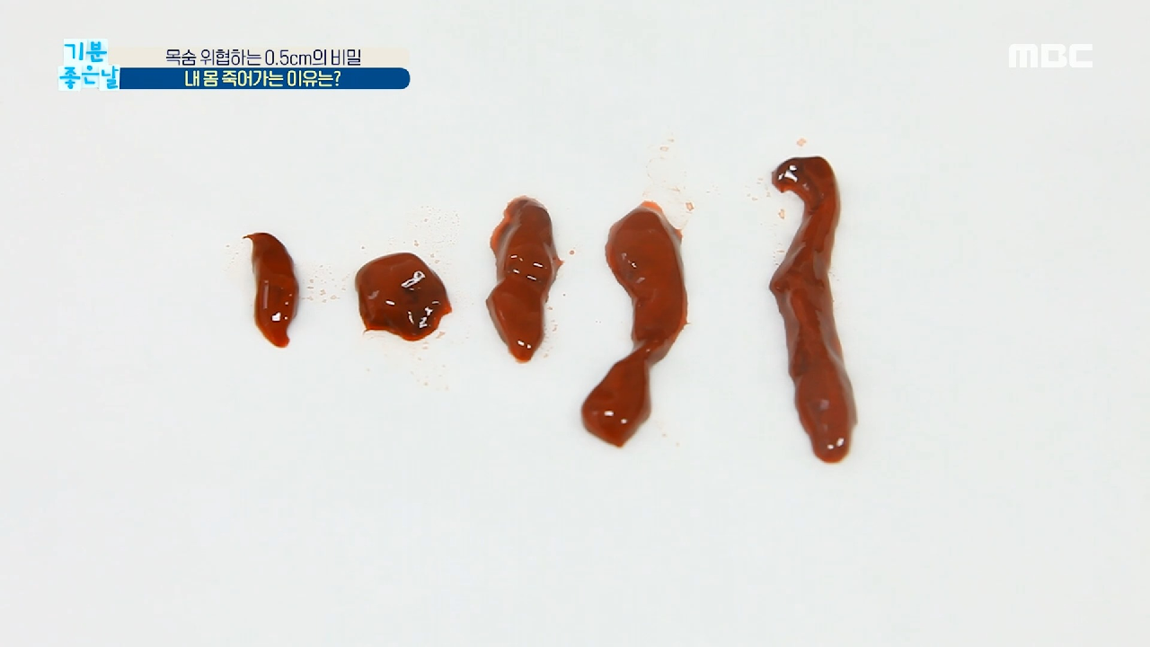  기분 좋은 날 혈전 원인 증상 치료 예방 혈관 건강 하지정맥류 원인 증상 치료 예방 하지정맥 아웃 종아리 운동 초간단 물병 운동