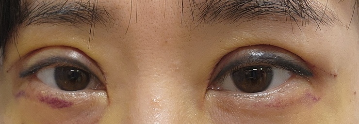 상안검 수술5일차
