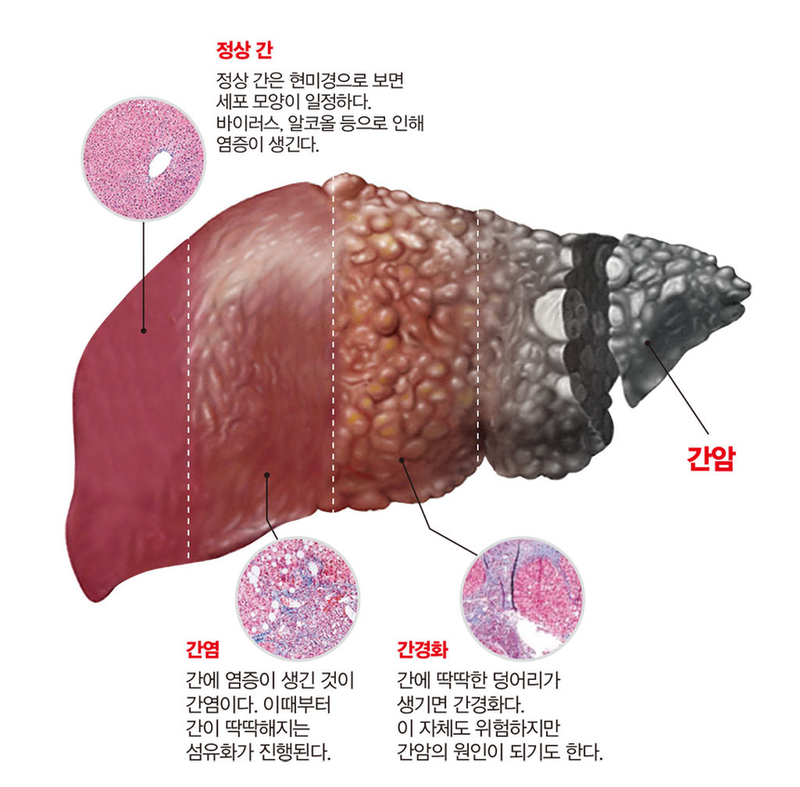 간경화 증상.  요법