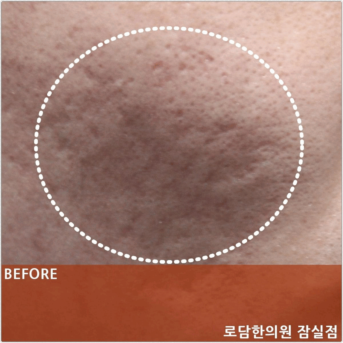  패인 여드름 흉터 치료 병원 말고 한의원에서 새살침을