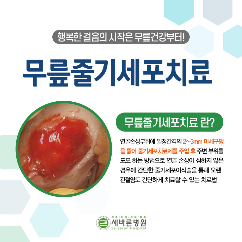  무릎통증 치료 본인의 무릎연골을 최대한 살려