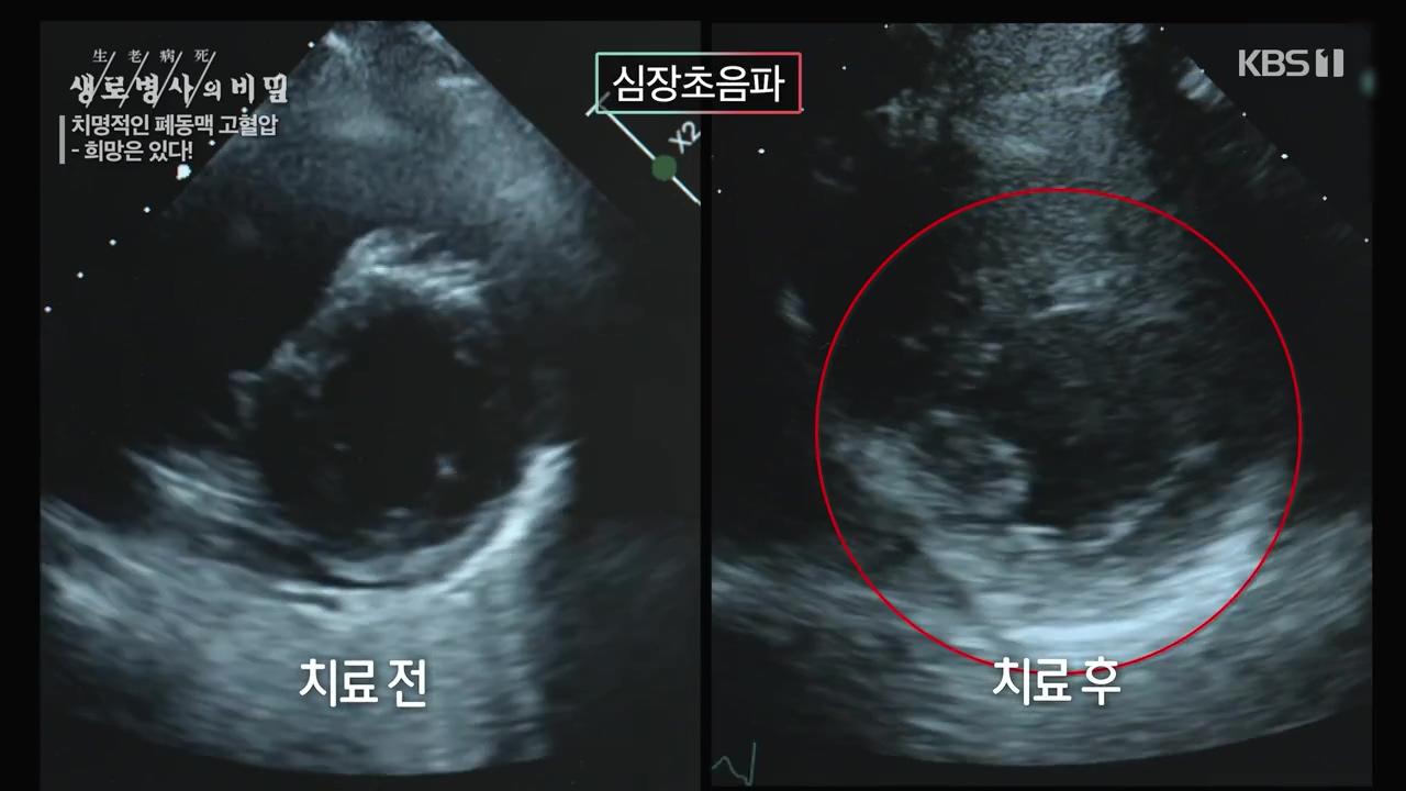 생로병사의 비밀.E900.240215p-NEXT.mp4_20240215_201746.619.jpg