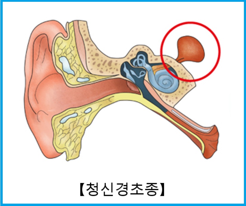 청신경초종