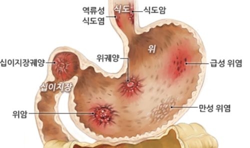 위암 초기증상 원인 특징 자가진단 정보 총정리2