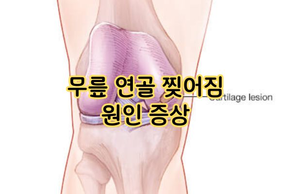 무릎 연골 찢어짐 원인 증상