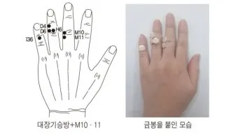 두통 수지침 편두통 혈자리_20