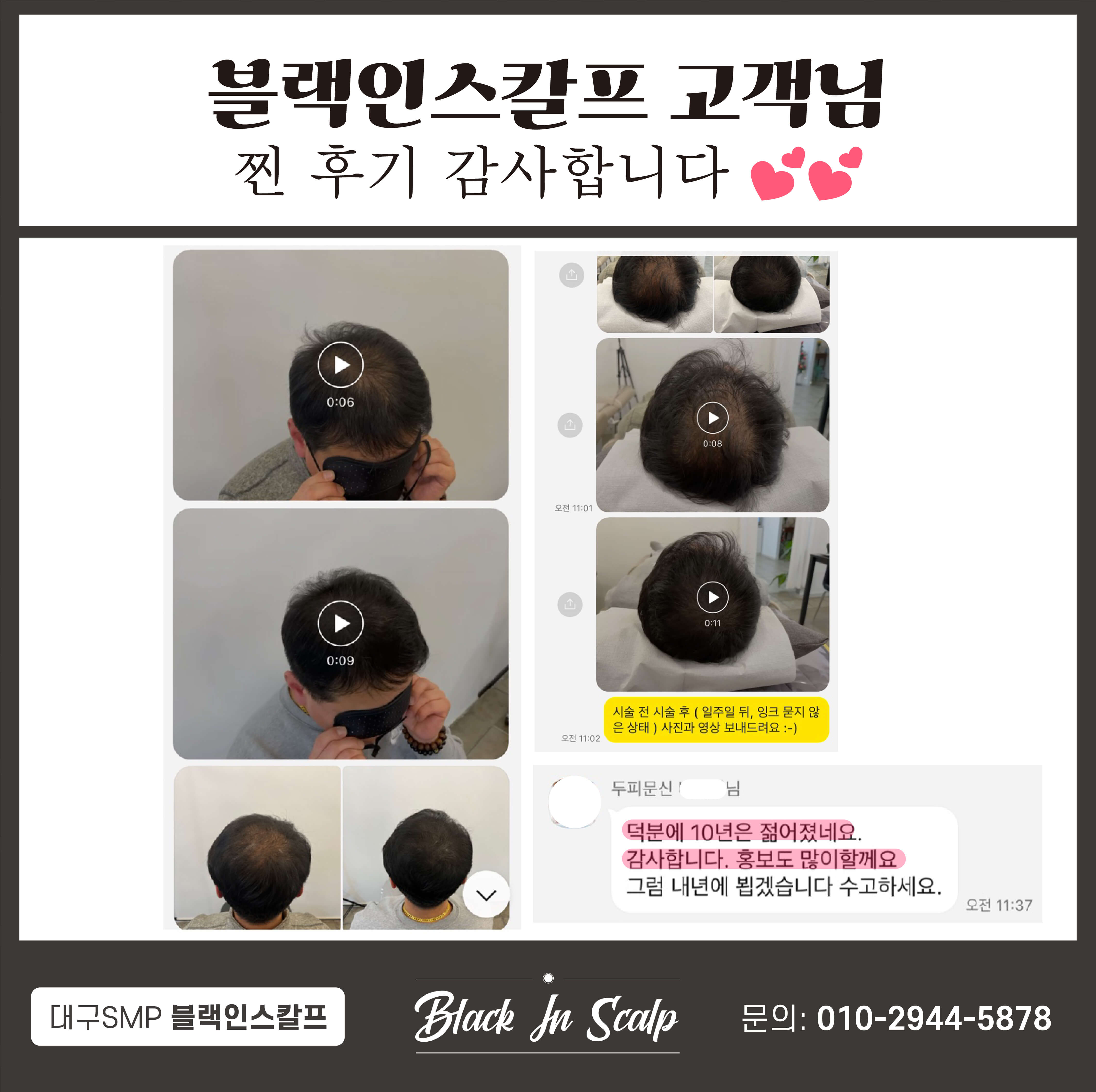 도트인스칼프 이미지