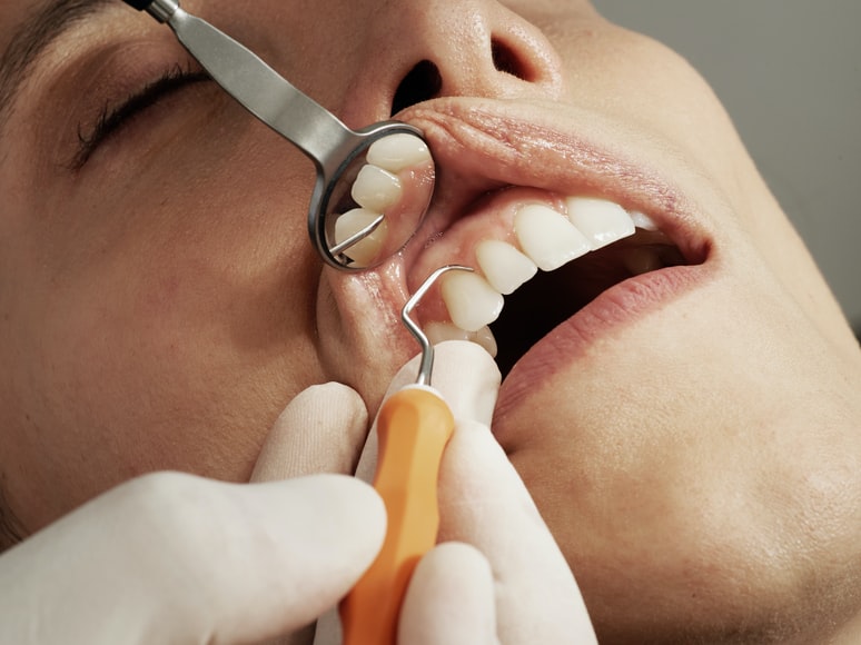치과 진료를 받고 있는 사진 입을 벌리고 치과용 기구로 입안을 살펴보고 있다