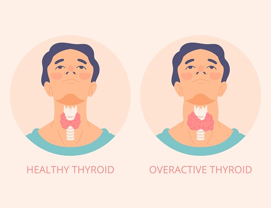 hypothyroidism